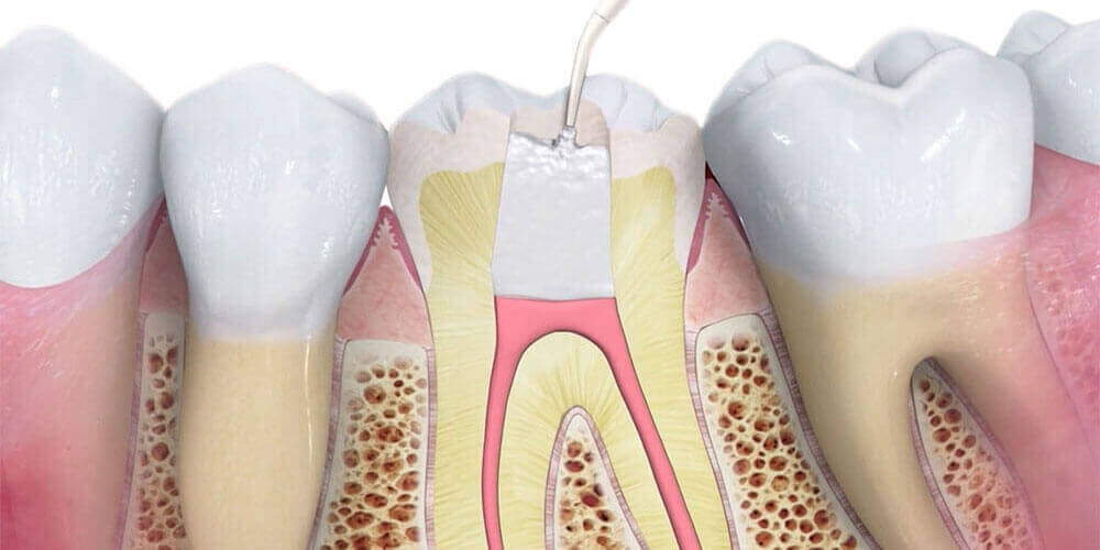 Root Canal Treatment Olds